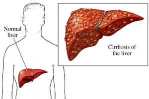 liver cirrhosis3