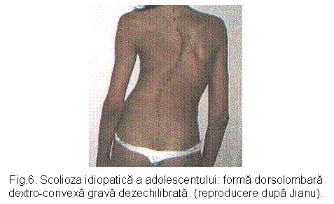 Text Box: 
Fig.6. Scolioza idiopatica a adolescentului: forma dorsolombara
dextro-convexa grava dezechilibrata. (reproducere dupa Jianu).

