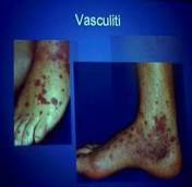 vasculite1.jpg