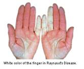 raynauds_disease.jpg