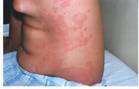 urticarie cr.jpg