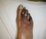 extremities-toe-gangrene2