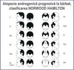 alopecia androgenica (a barbatilor).jpg