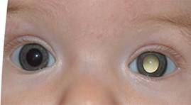 https://www.stjude.org/Images/misc-retinoblastoma-0602.jpg