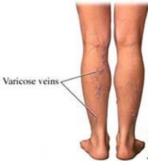Primele semne și simptome ale varicelor pe picioare: ce trebuie să faci? - Articole - August