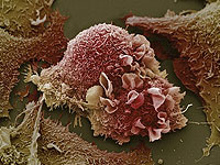 Celule canceroase din plamani