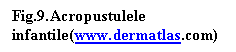 Text Box: Fig.9.Acropustulele infantile(www.dermatlas.com) med.)