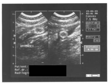 Ultrasound appearances of acute appendicitis