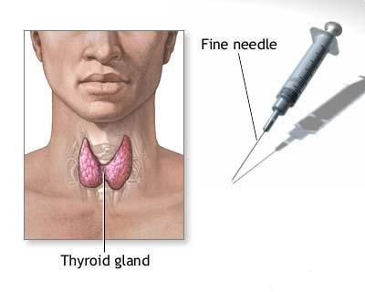Biopsie tiroidiana