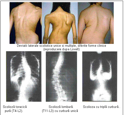 Text Box: 
Deviatii laterale scoliotice unice si multiple, diferite forme clinice
(reproducere dupa Lovell)
 

Scolioza toracica Scolioza lombara. Scolioza cu tripla curbura..
 pura (T4-L2). (T11-L3) cu curbura unica
