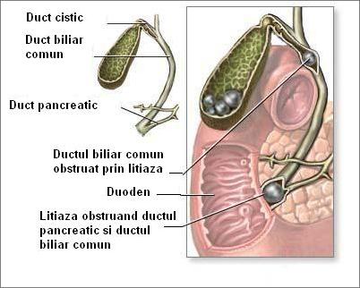 Litiaza coledociana