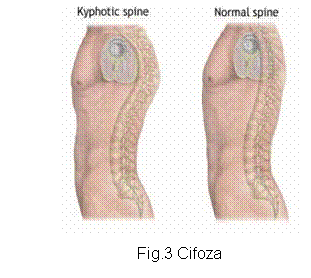 Text Box: 
Fig.3 Cifoza
