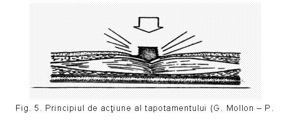 Text Box: 
Fig. 5. Principiul de actiune al tapotamentului (G. Mollon - P. Dotte)
