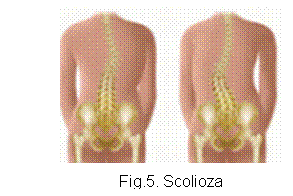 Text Box:  
Fig.5. Scolioza

